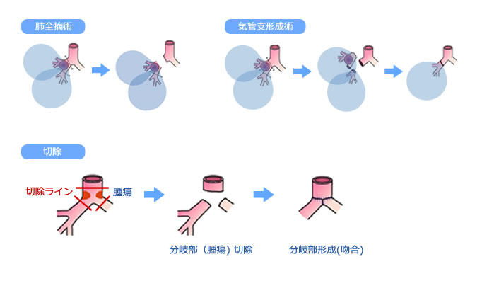気管・気管支形成術の過程