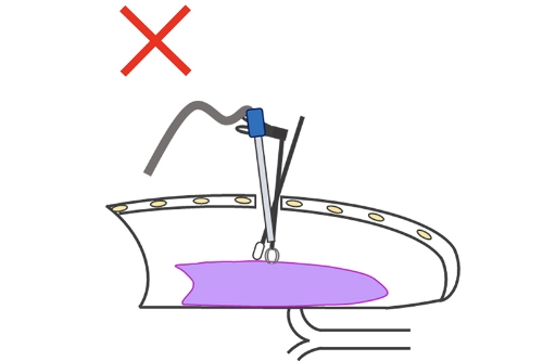 胸腔鏡手術（単孔式）