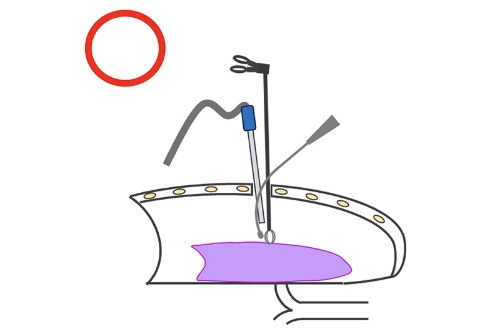 胸腔鏡手術（単孔式）