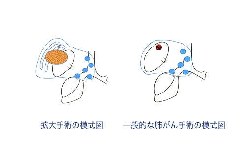 拡大手術の模式図・一般的な肺がん手術の模式図