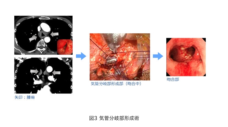 図3 気管分岐部形成術