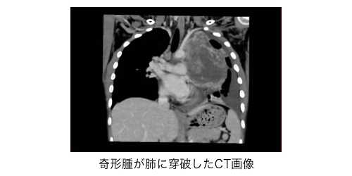 非セミノーマ