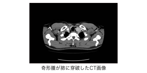 リンパ系腫瘍