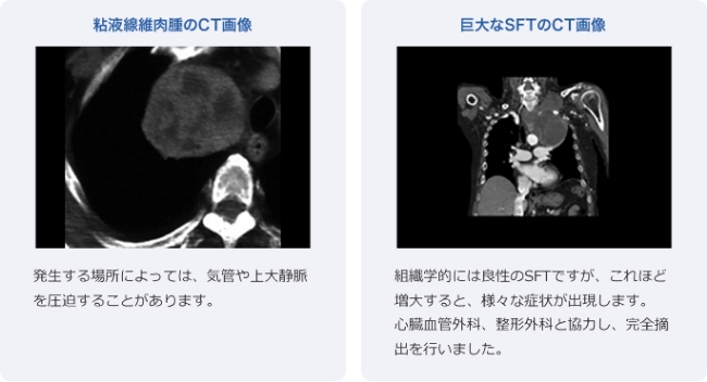 その他の腫瘍