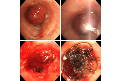 悪性腫瘍による気道狭窄あり、レーザー治療後、ステント留置