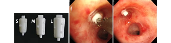 難治性気胸に対して、気管支充填剤（EWS）を用いた処置